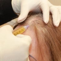 Как проходит терапия PRP?