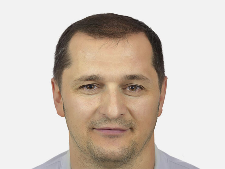 После Пересадки Волос