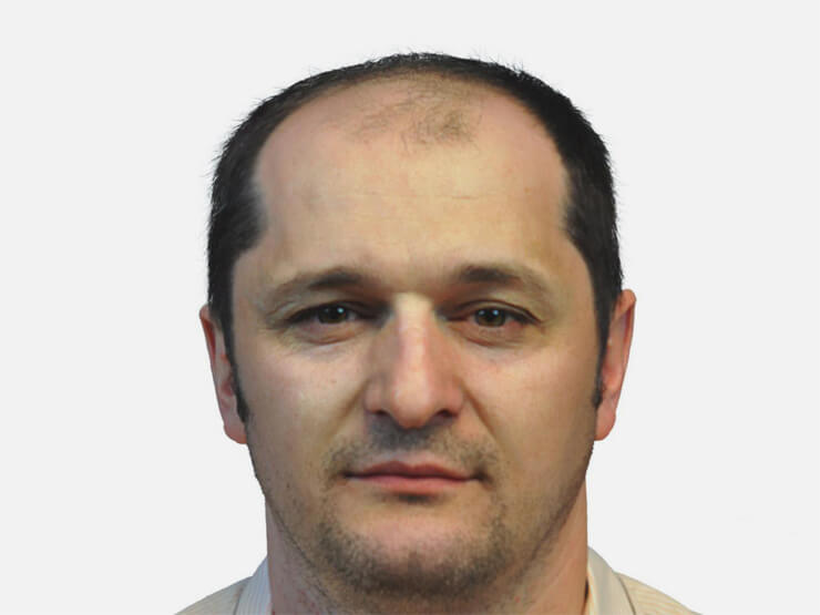 До Пересадки Волос