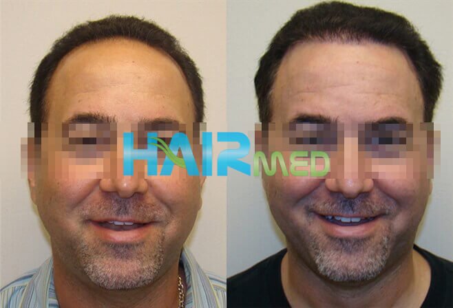 Фотографии до и после пересадки волос