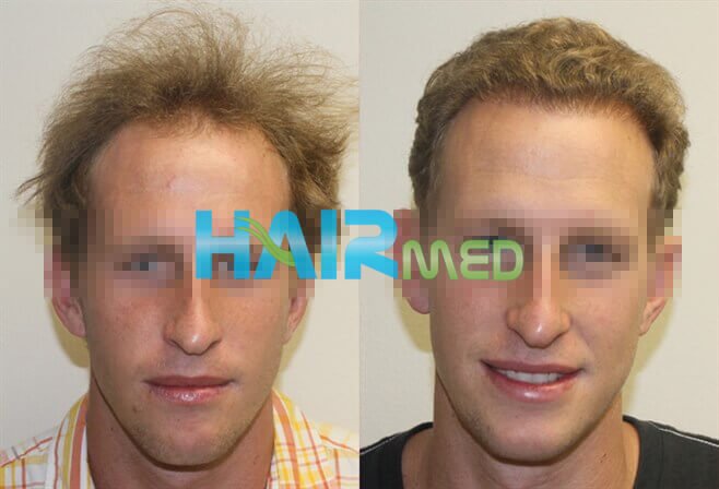 Фотографии до и после пересадки волос